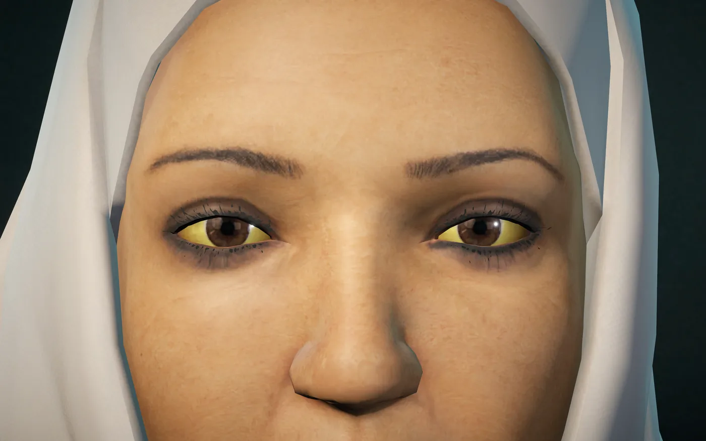 Close-up of the patient’s eyes, showing yellow sclerae